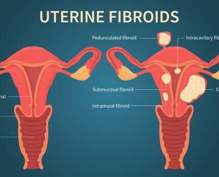 Risk Factors for Uterine Fibroids Among Black Women