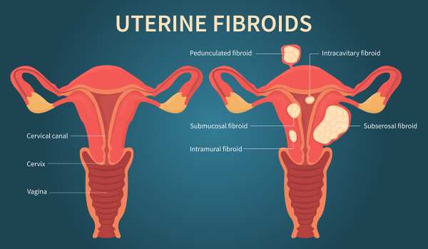 Risk Factors for Uterine Fibroids Among Black Women