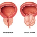 Male Health and Prostate Diseases
