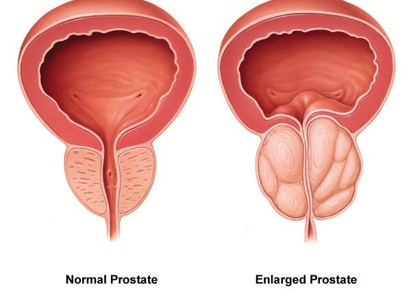 Male Health and Prostate Diseases Male Health and Prostate Diseases