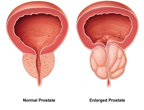 Male Health and Prostate Diseases Male Health and Prostate Diseases