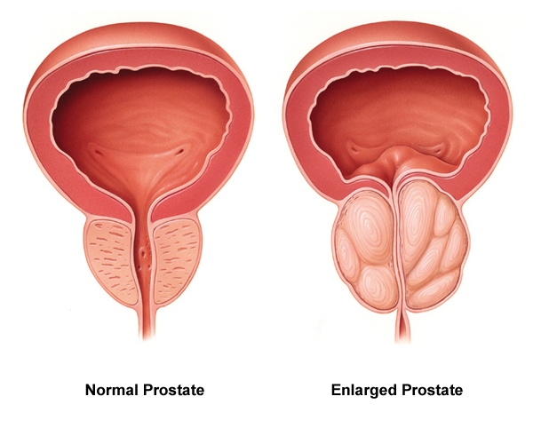 Male Health and Prostate Diseases